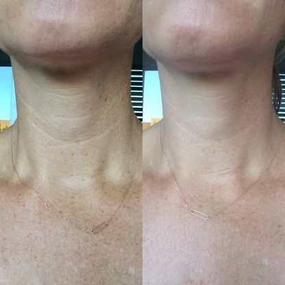 Oppstrammende Kollagenhalsmaske