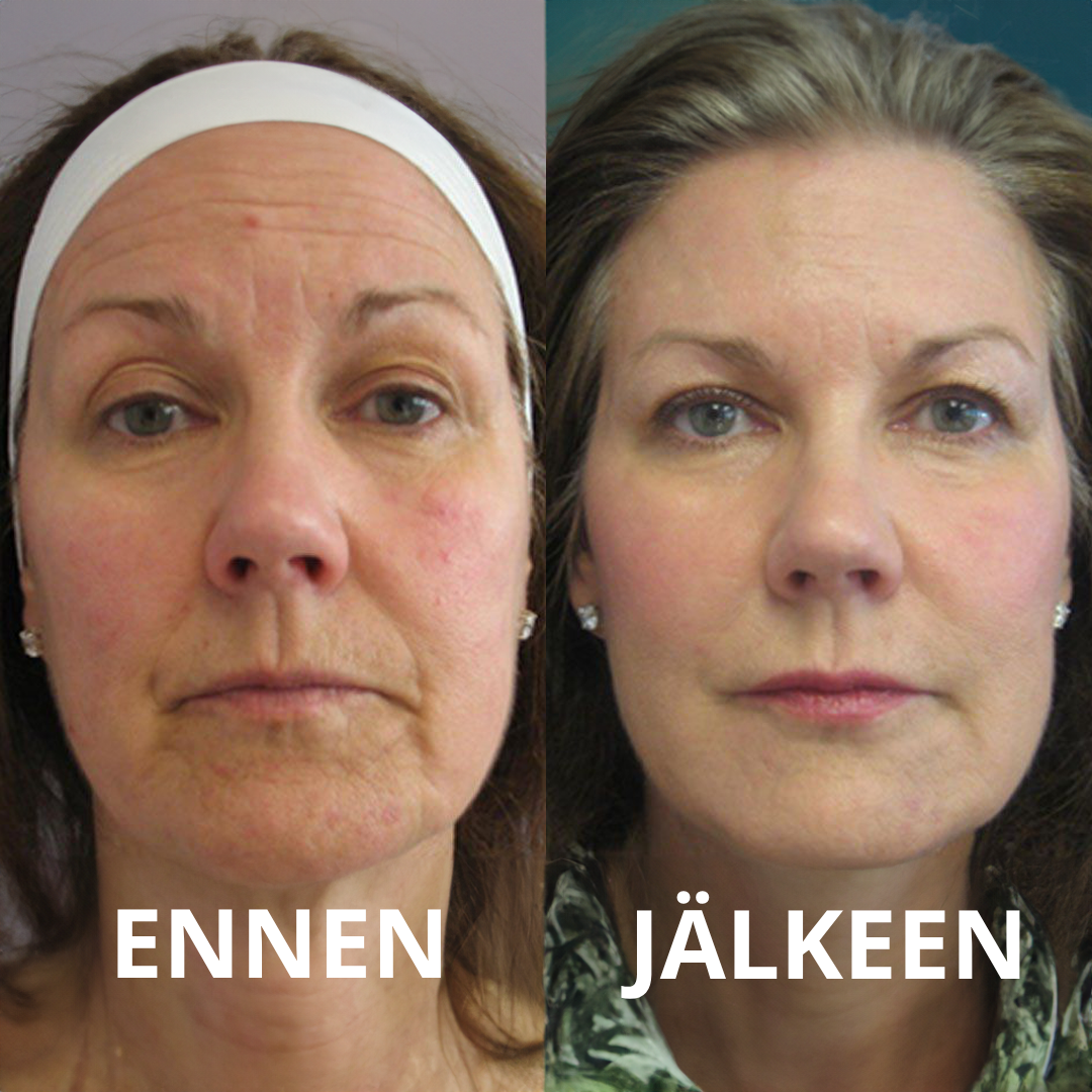 Bio-Kollagenmaske for Dyp Fukt og Glød