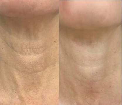 Oppstrammende Kollagenhalsmaske