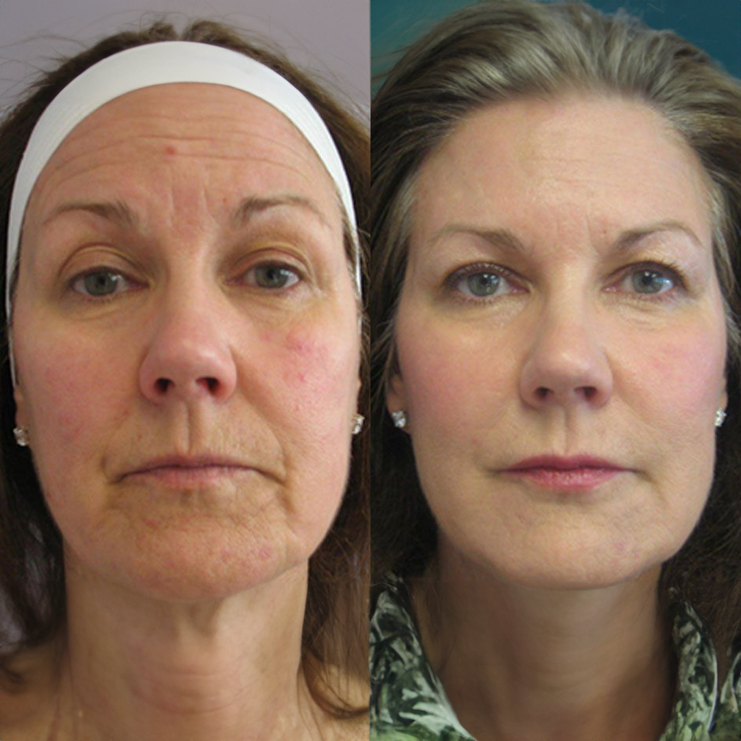 Dypt Fuktighetsgivende Bio-Kollagenmaske